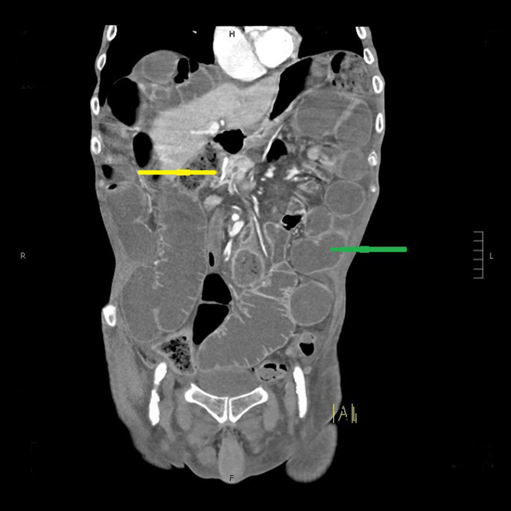 Coronal view of computed tomographic scan showing swirling of the mesentery (yellow arrow) and dilated loops of small bowel (green arrow).