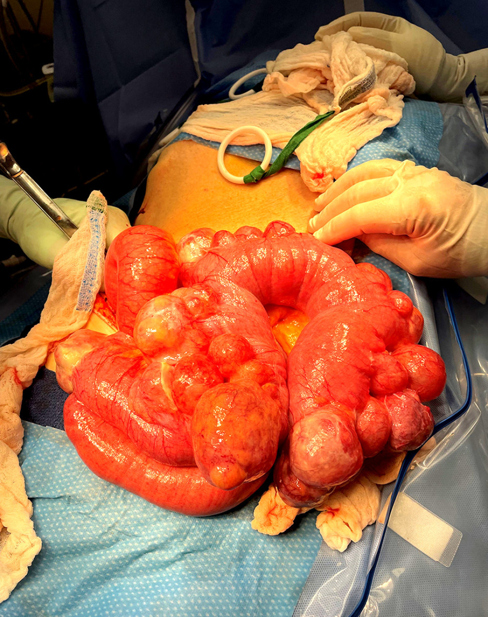 Surgical specimen showing resected segment of dilated proximal jejunum with large jejunal diverticula, with some diverticula showing ischemic changes.