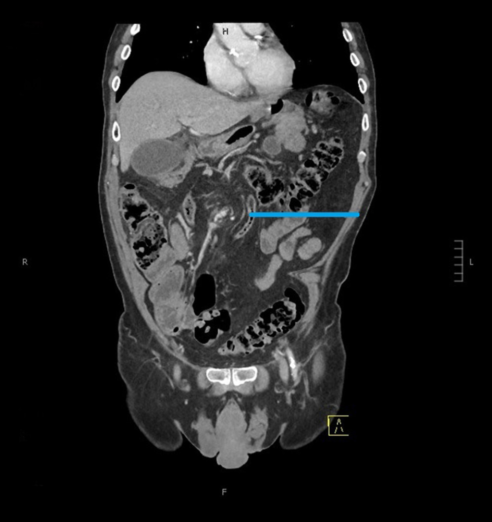 Coronal view of a computed tomographic scan from 5 years prior to presentation showing mesenteric swirling (blue arrow) but normal bowel caliber and orientation.