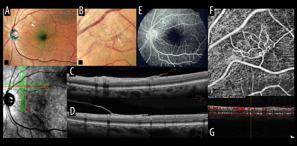 Multimodal imaging of the left eye. (A, B) Multicolor imaging shows a semi-translucent membrane in the superior temporal vascular arcade with an associated flat vascularization complex of thin vessels (white arrow). (C, D). Spectral domain optical coherence tomography reveals a thick pre-retinal hyper-reflective line with no vitreoretinal traction and a subtle irregularity in the inner and intermediate retina layers. See horizontal (C) and vertical (D) cross-section. (E) Fluorescein angiography exposes localized hyperfluorescence with leakage corresponding to the thin vessels observed (asterisk). No areas of capillary closure were identified. (F, G) Optical coherence tomography angiography shows a high-flow abnormal vascular complex with unbranched long dilated filamentous vessels similar to pruned-vascular-tree pattern in the superficial capillary plexus. Note how OCT-A en-face superficial cross-section (F) shows that the borders of the vascular complex have more fine vessels and how it exactly correlates with the high-flow observed in the OCT-A B-scan (G).