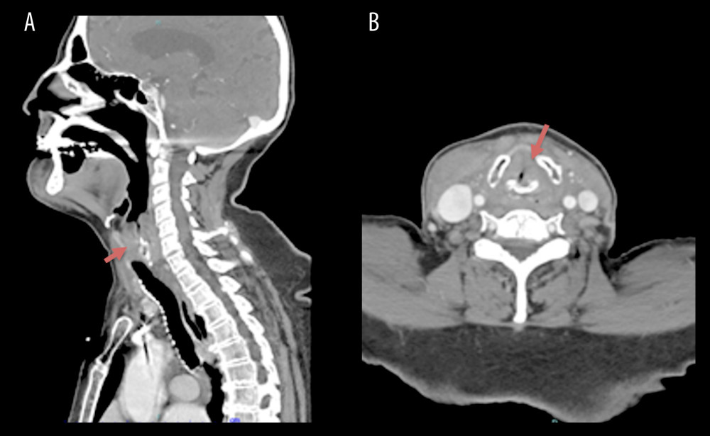 Sagittal (A) and transverse (B) views of CT of the neck with contrast, showing soft-tissue swelling/edema from the lower hypopharynx to the epiglottis and marked narrowing of the airway (red arrow).