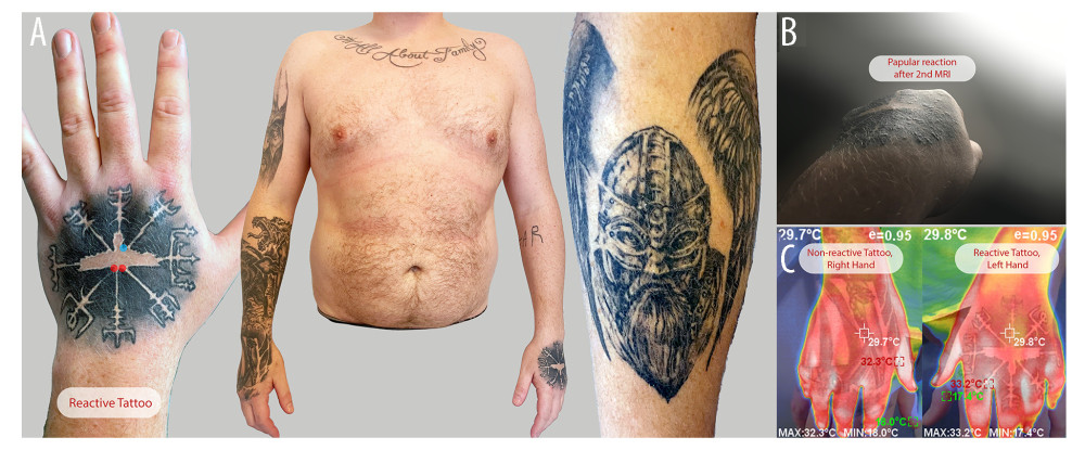 (A) Overview of the patient’s tattoos. Left dorsal hand, reactive tattoo (early October 2022). Red circles indicate initial biopsy locations; the blue circle shows the second biopsy site post-MRI. The broader view depicts tattoos on the right arm (mid-2021 to early 2022), upper-chest lettering (2017), and a right leg tattoo (late 2021). (B) Reactive tattoo, a few days after the second MRI. The patient reported multiple papules in a follicular pattern within the black tattoo. The photo was taken by the patient in natural daylight. (C) IR thermography of the right versus left hand tattoo after the MRI test session. There was no significant thermal difference between the 2 hand tattoos.
