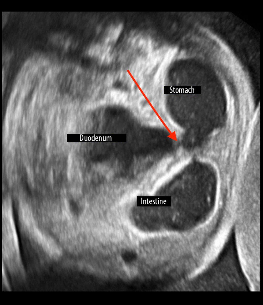 Two-dimensional image. Dilated stomach, duodenum, and intestine are visible. Duodenum stenosis and bloated stomach are indicated by red arrow.