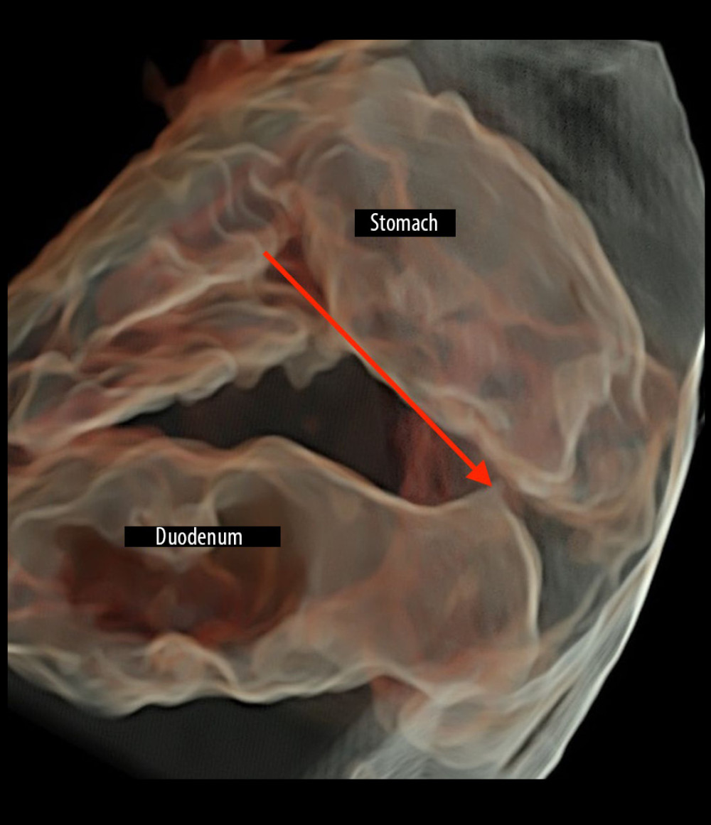 HDlive silhouette image. Bloated stomach and duodenum are visible. The duodenum lumen is visible. The use of HDlive silhouette mode enabled precise localization of the stenosis site. Duodenum stenosis and bloated stomach are indicated by red arrow.