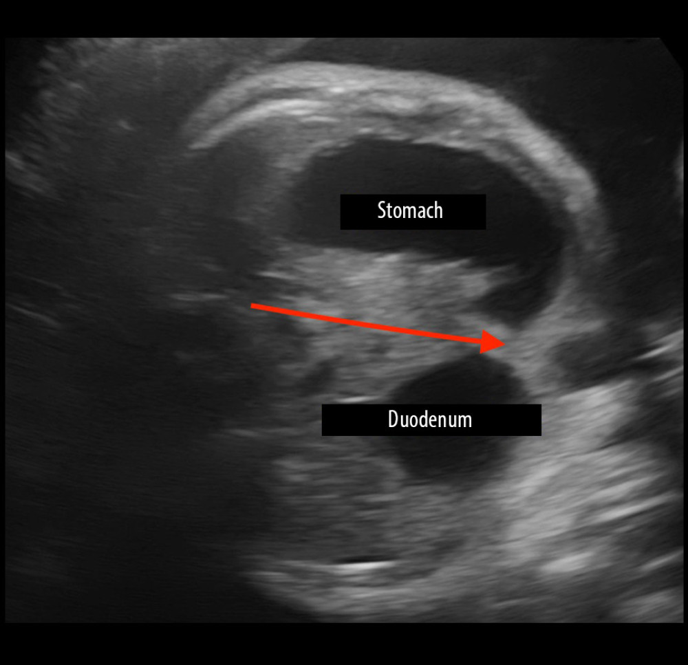 Two-dimensional image. Dilated stomach, duodenum, and intestine are visible. Duodenum stenosis and bloated stomach indicated by red arrow.
