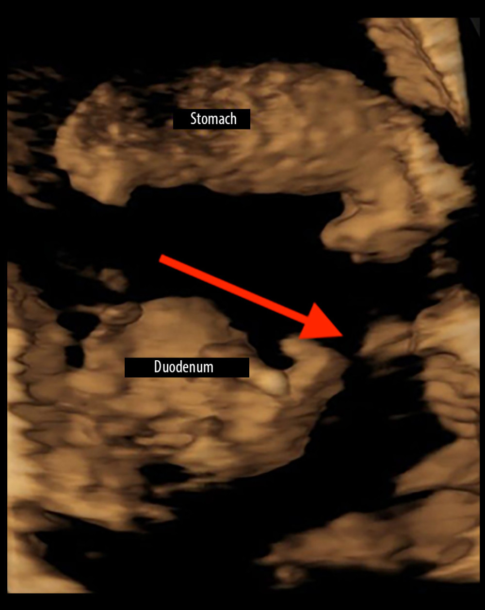 HDlive inversion image. Bloated stomach, duodenum are visible. Duodenum stenosis and bloated stomach are indicated by red arrow.