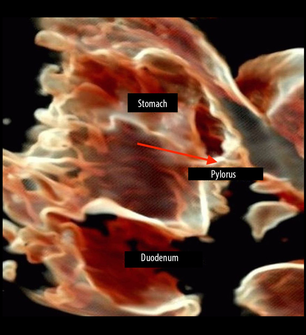HDlive image. The interior of pathologically changed segment of the alimentary tract was visualized, which facilitated localization of the stenosis. Duodenum stenosis and bloated stomach are indicated by red arrow.
