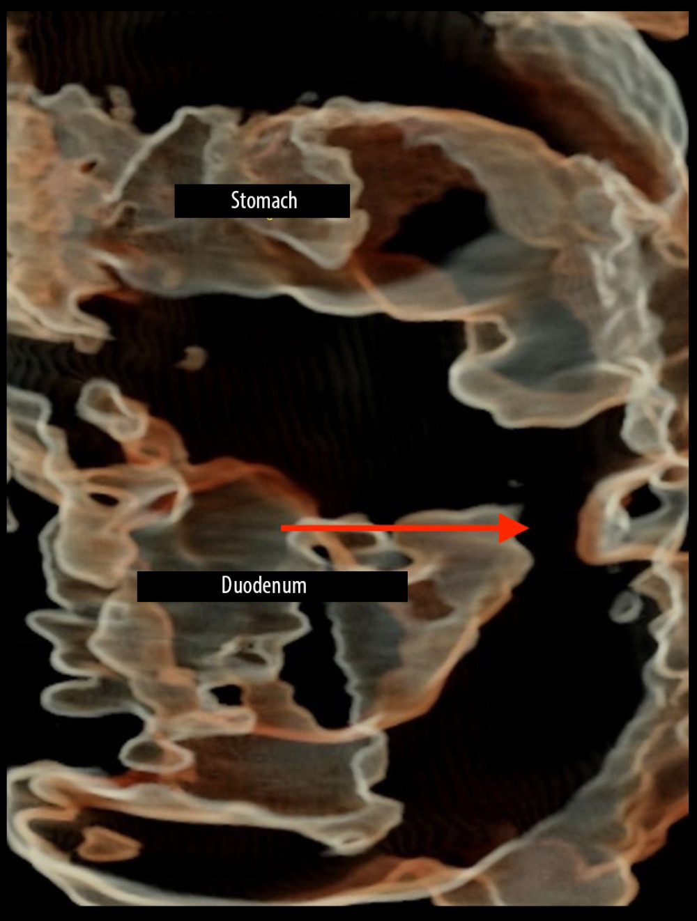 HDlive silhouette image. The interior of a pathologically changed segment of the alimentary tract was visualized, which facilitated the localization of the stenosis using the silhouette function, which shows better contours. Duodenum stenosis and bloated stomach are indicated by red arrow.