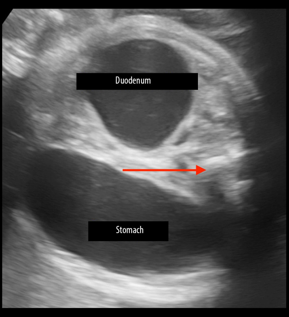 Two-dimensional image. Double bubble symptom is visible. Duodenum stenosis and bloated stomach are indicated by red arrow.