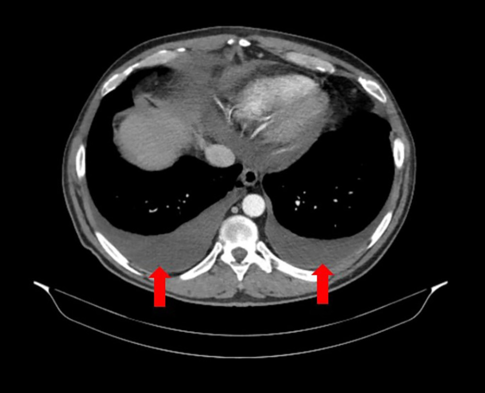 Computed tomography image of thorax in transversal incidence angle. Bilateral pleural effusion, more exacerbated on the right side after diagnostic thoracentesis (arrows).