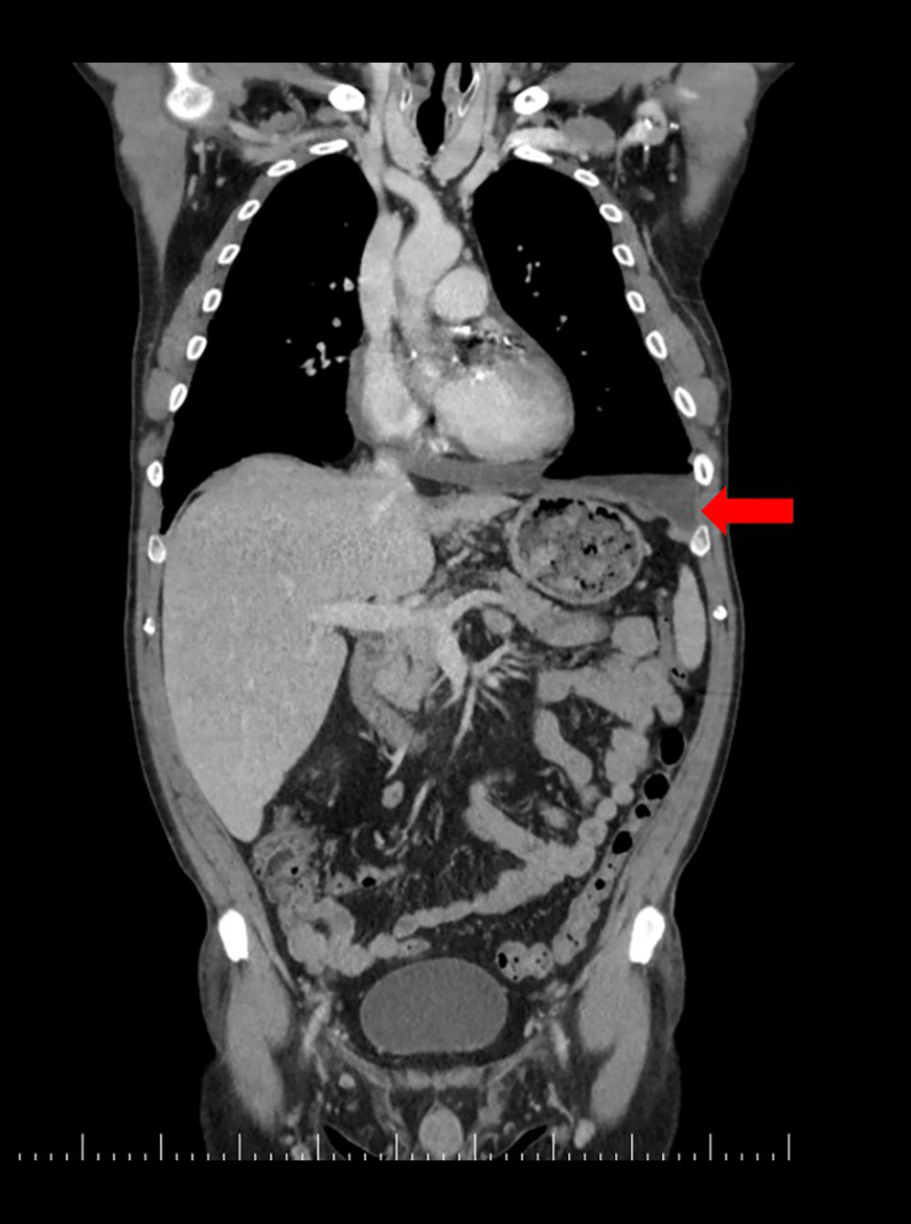 Computed tomography image of thorax, abdominal cavity, and pelvis in anterior incidence angle. In this incidence angle only the left side pleurisy is observable (arrow).