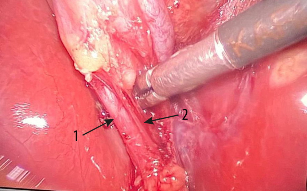 Cystic duct (arrow 1) and cystic artery (arrow 2) dissected before ligation.