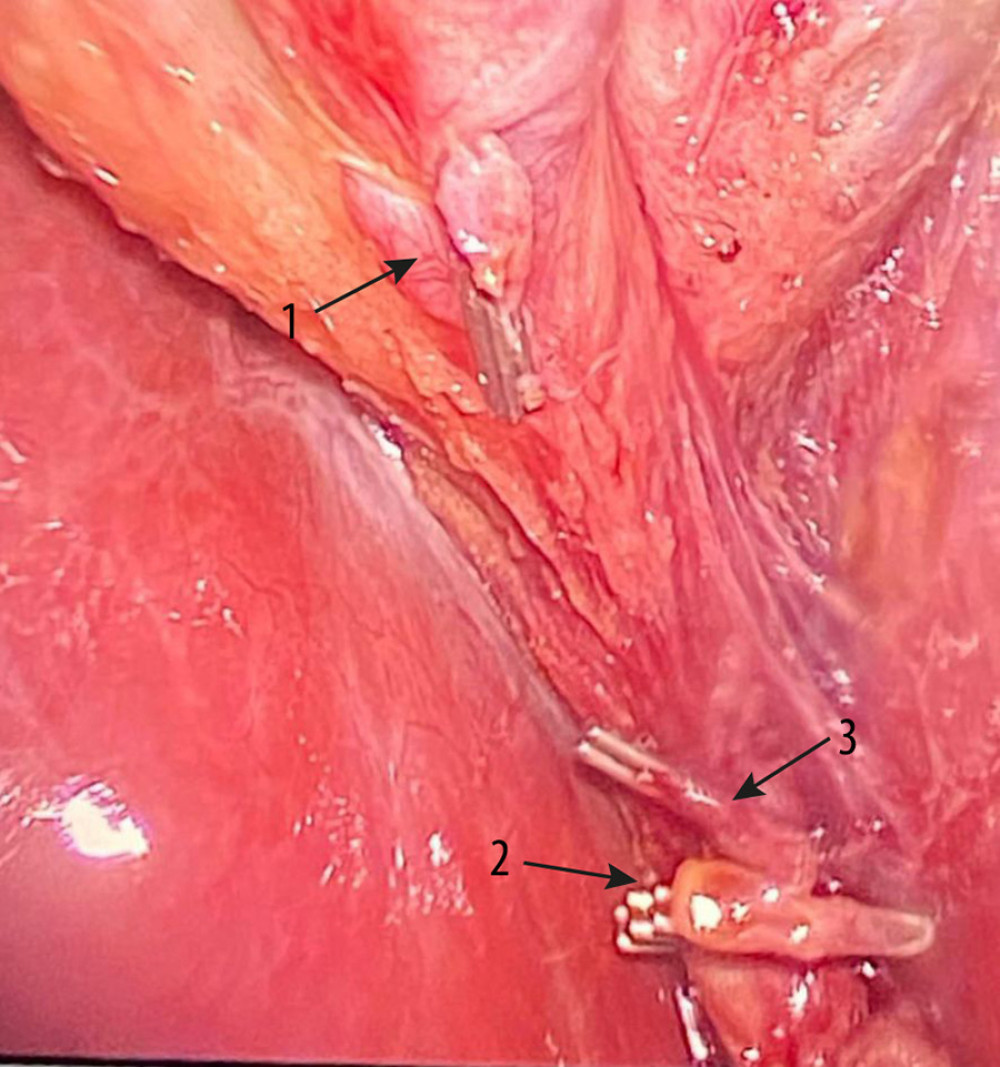 Cystic duct (clips at arrows 1 and 2) and cystic artery (clip at arrow 3) dissected after ligation.