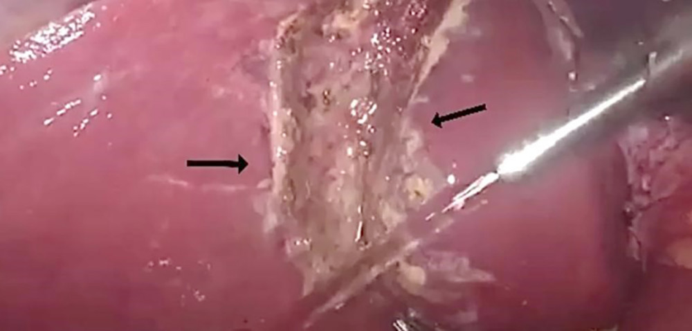Irrigation of gallbladder fossa (arrows).