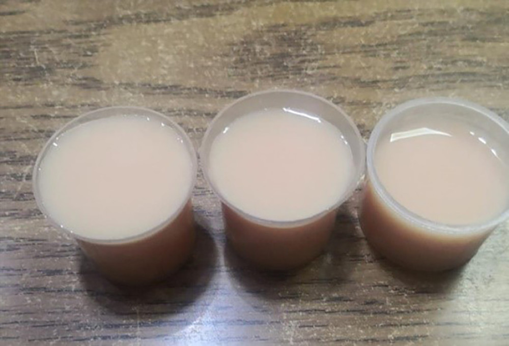Chyle fluid from drain following laparoscopic cholecystectomy for acute cholecystitis postoperative day 2.