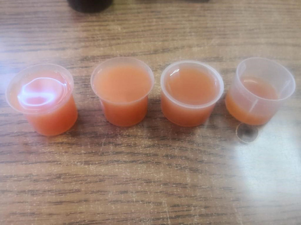 Fluid from drain following laparoscopic cholecystectomy for acute cholecystitis postoperative day 5.