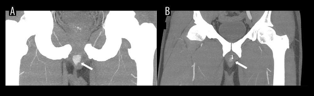 Angiographic CT in horizontal plane. Panel A (left) shows the preprocedural exam, with the arrow pointing at contrast medium extravasation. Panel B (right) displays the postprocedural exam, with the arrow pointing at a minimal contrast leakage into the corpora cavernosa.