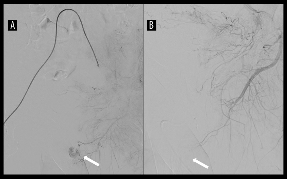 Periprocedural digital subtraction angiography. Panel A (left) shows the angiogram before microcoiling, with the arrow indicating a fistula between the distal segment of the internal pudendal artery and corpora cavernosa. Panel B (right) displays the control angiography, with the arrow indicating remnant filling of the fistula from the right side.