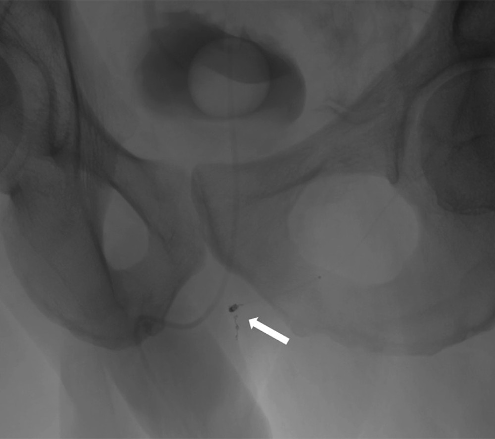 Periprocedural fluoroscopy, with the arrow indicating the localization of the microcoils.