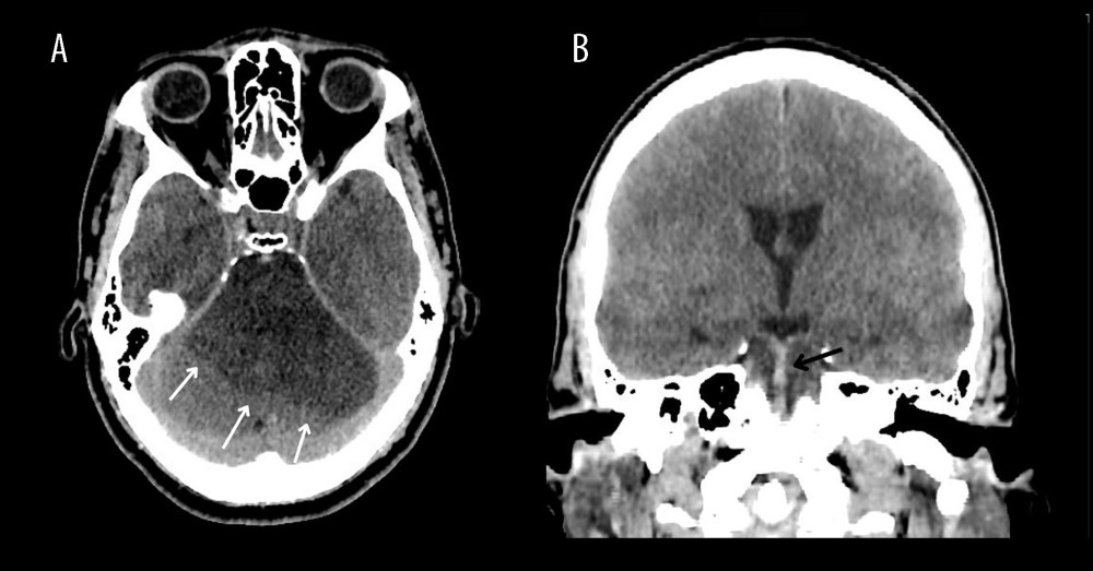 Plain head computed tomography showing A) an extensive ischemic event in the posterior fossa (white arrows); B) a hyperdense basilar artery suggestive of basilar artery occlusion (black arrow).