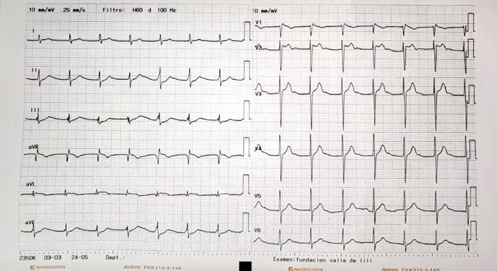 Initial ECG showing Brugada type II pattern (ST-segment elevation ≥2 mm in right precordial leads followed by positive or biphasic T waves, resembling a saddleback configuration). Additionally, the aVR sign (prominent R wave) is identified.