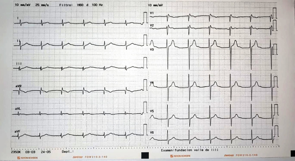 Second ECG with placement of right precordial leads in upper intercostal spaces, showing Brugada type III pattern (descending ST-segment elevation ≤1 mm, followed by negative T waves).