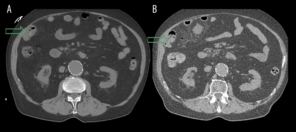 (A) Chest/abdomen CT, initially described as unremarkable. (B) Chest/abdomen CT on the following day. Short wall thickening of the small intestine and intraluminal small hyperdense structure of 2 cm length was retrospectively already visible on the previous day (arrows). CT – computed tomography.