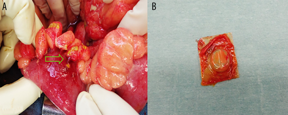 (A) Perforation site of the small intestine (arrow). (B) Empty, sharp-edged blister.