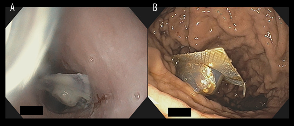 (A) Empty medication blister in the esophagus. (B) Empty medication blister in the stomach corpus.