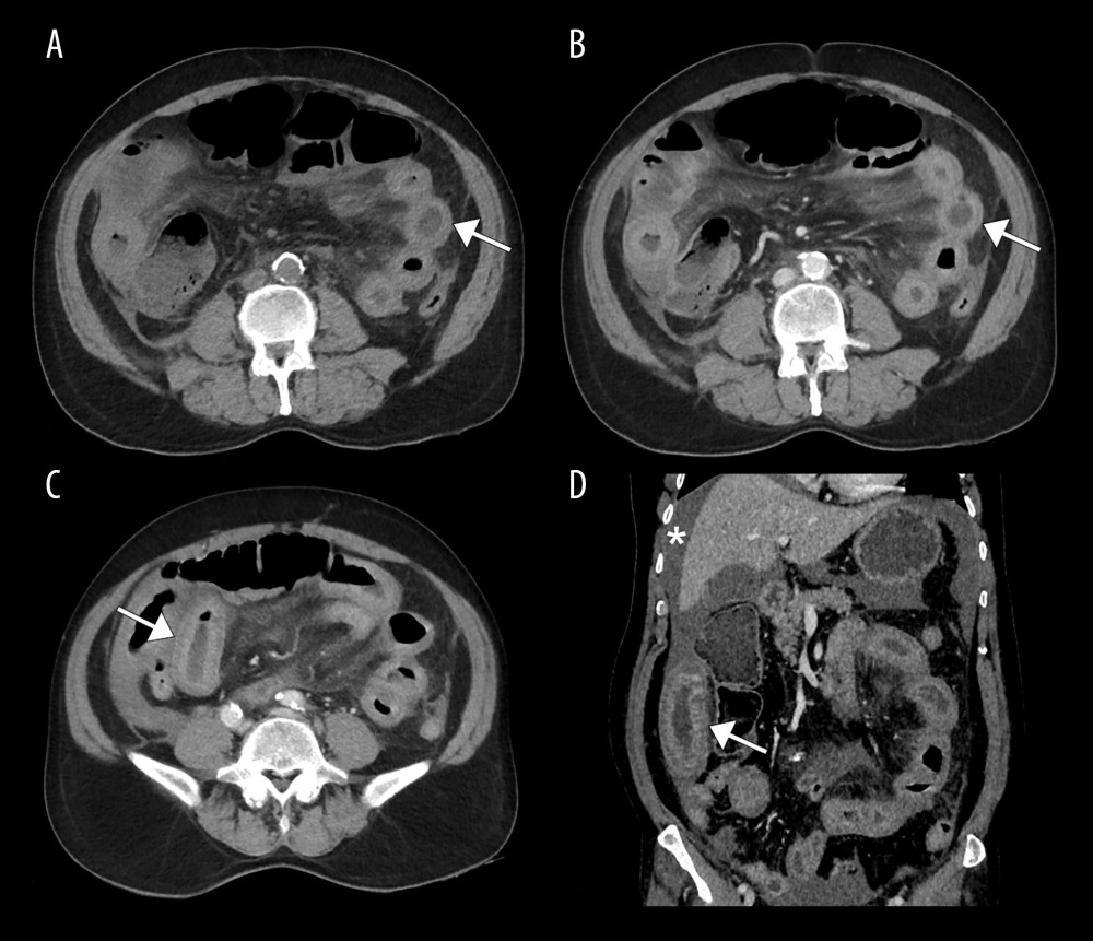 Axial (A–C) and coronal (D) CT abdomen images in the non-contrast (A) and portovenous phases (B–D) show circumferential thickening (arrows) of the small intestinal wall with increased density evident on the non-contrast image (A), and further characterized by contrast enhancement during the portovenous phases. The presence of hemoperitoneum is also noted (asterisk). These findings collectively suggest the diagnosis of an intramural small intestinal hematoma with associated hemoperitoneum.