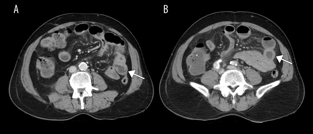 Axial image of CT abdomen illustrating the interval regression of previously observed thickened and hyperdense small bowel wall (arrows).