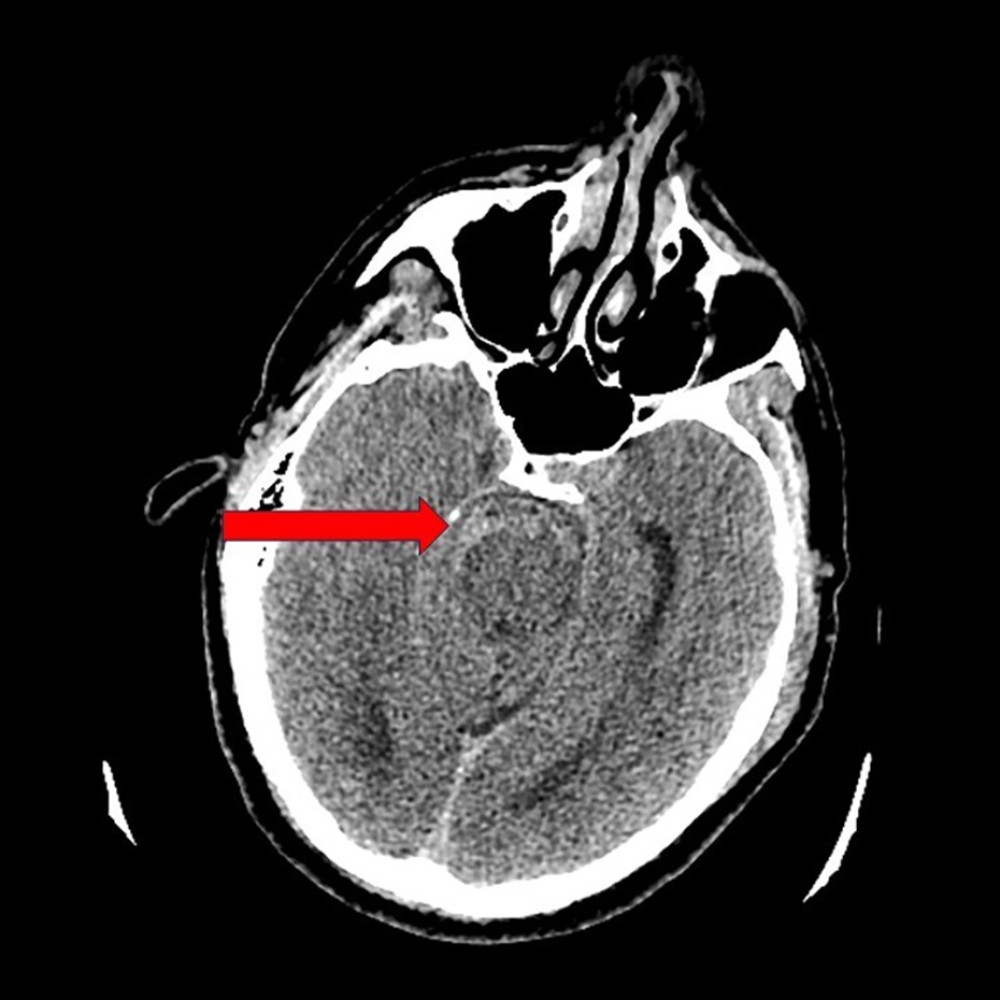 Initial non-contrast computed tomography scan, transverse plane, at the level of the midbrain. The red arrow points to the aneurysmal subarachnoid hemorrhage in the basal cistern.