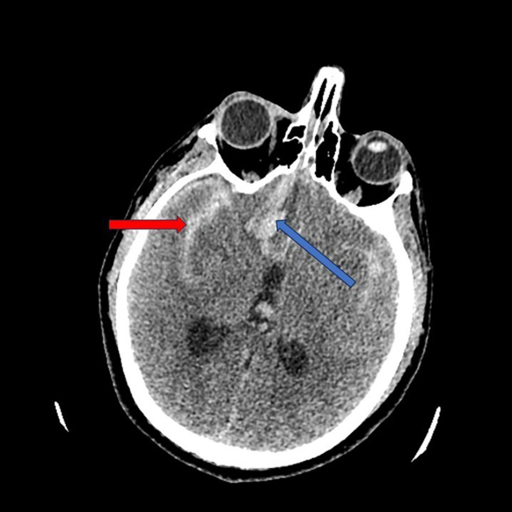 Initial non-contrast computed tomography scan, transverse plane, at the level of the third ventricle. The red arrow points to a subarachnoid hemorrhage located in the right temporal lobe. The blue arrow points to an intracerebral hemorrhage on the right frontal lobe.
