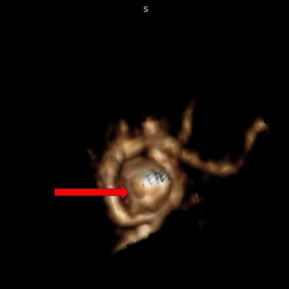 Initial computed tomography angiography, 3-dimensional reconstruction of the ruptured aneurysm. The red arrow points to the aneurysmal dome.