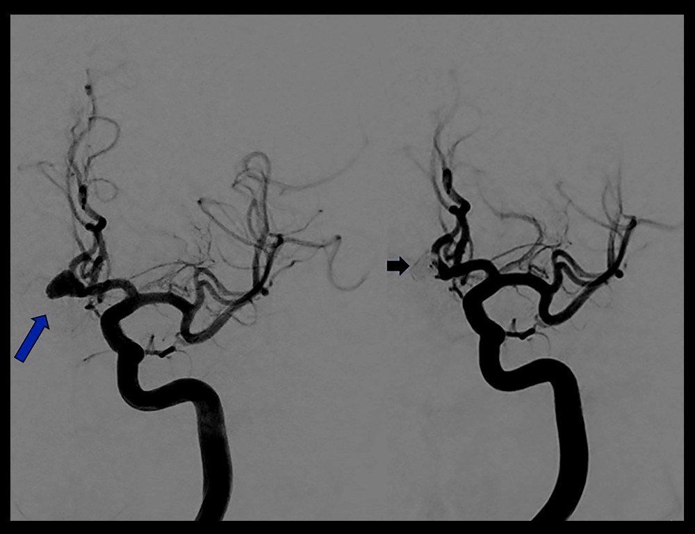 Digital subtraction angiography of the left internal carotid artery. On the left is the image before the treatment of the aneurysm. The blue arrow points to the aneurysmal dome. On the right is the image of the same vessel after coiling the aneurysm. The black arrow points to the area of the aneurysm that is successfully occluded.