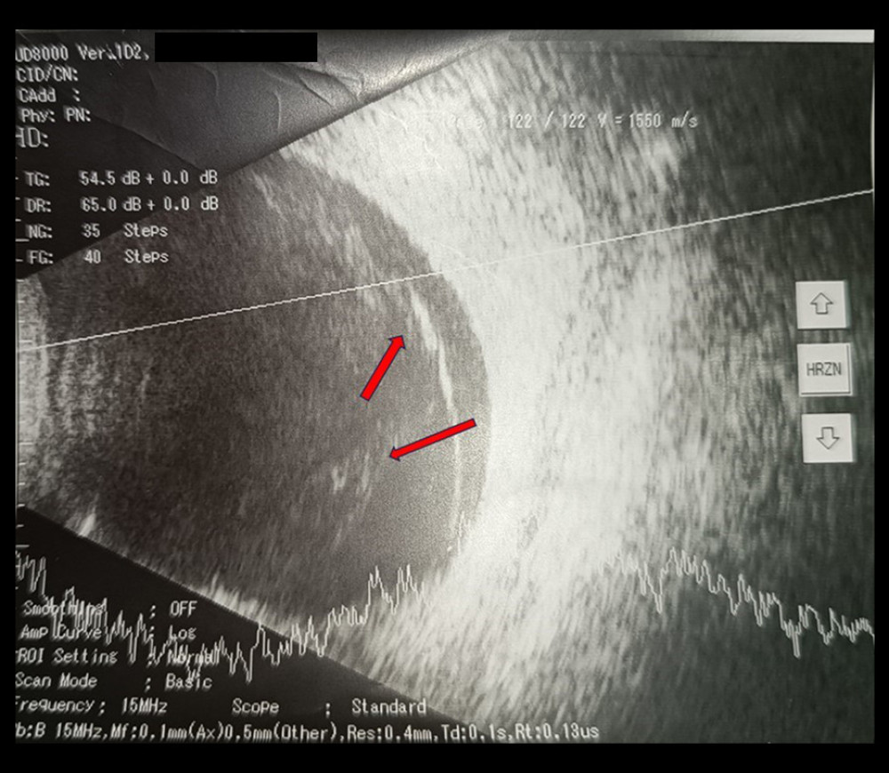 Ocular sonography of the first affected eye. The red arrows indicate fresh hemorrhage, diagnosing vitreous hemorrhage.