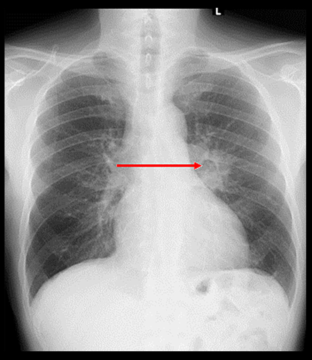 A 65-year-old male patient’s screening chest X-Ray. The arrow indicates a nodularly enlarged hilum of the left lung.