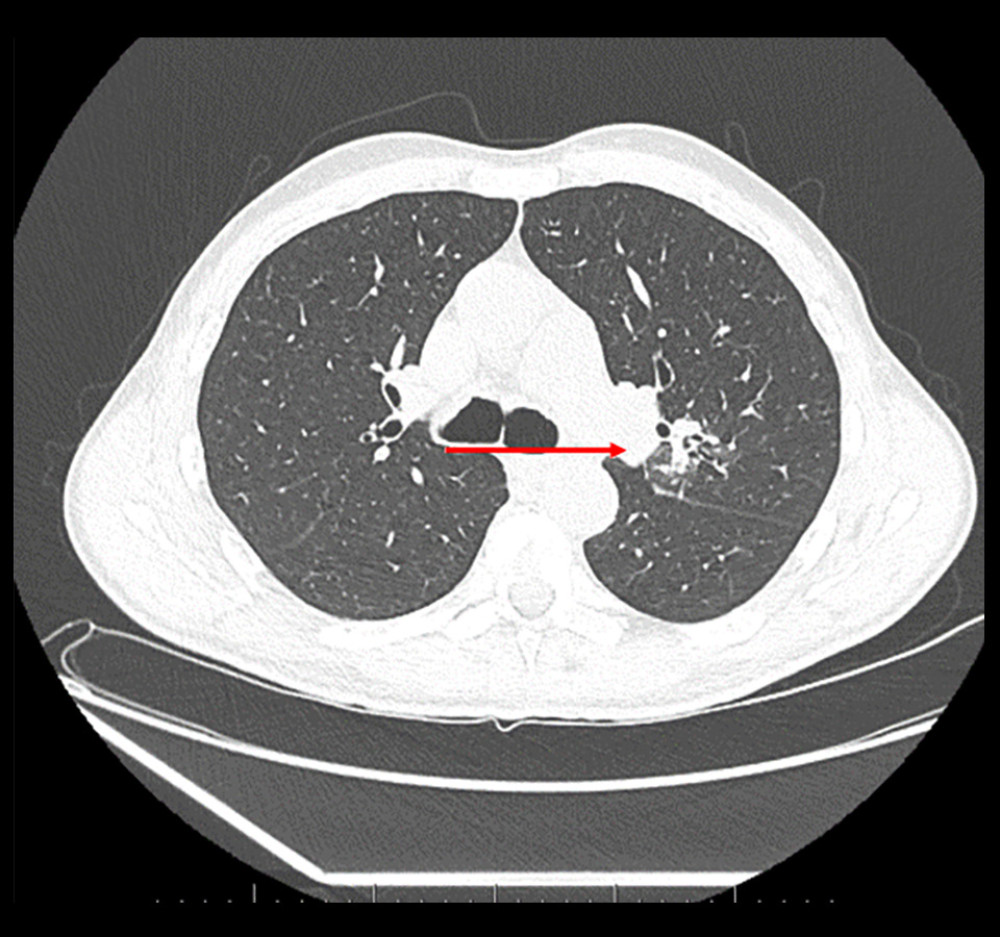 Chest computed tomography scan from March 1, 2023 (lung window). The arrow indicates a infiltration-nodal mass of the left lung hilum.
