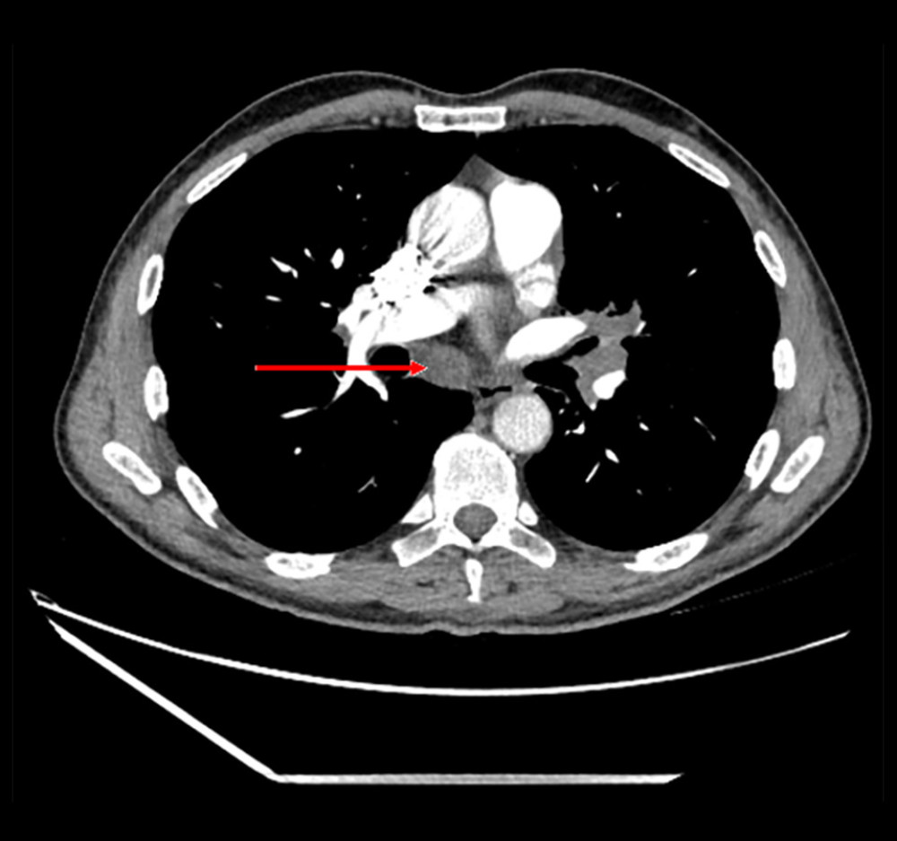 Chest computed tomography scan from March 1, 2023 (contrast-enhanced). The arrow indicates an enlarged subcarinal lymph node.