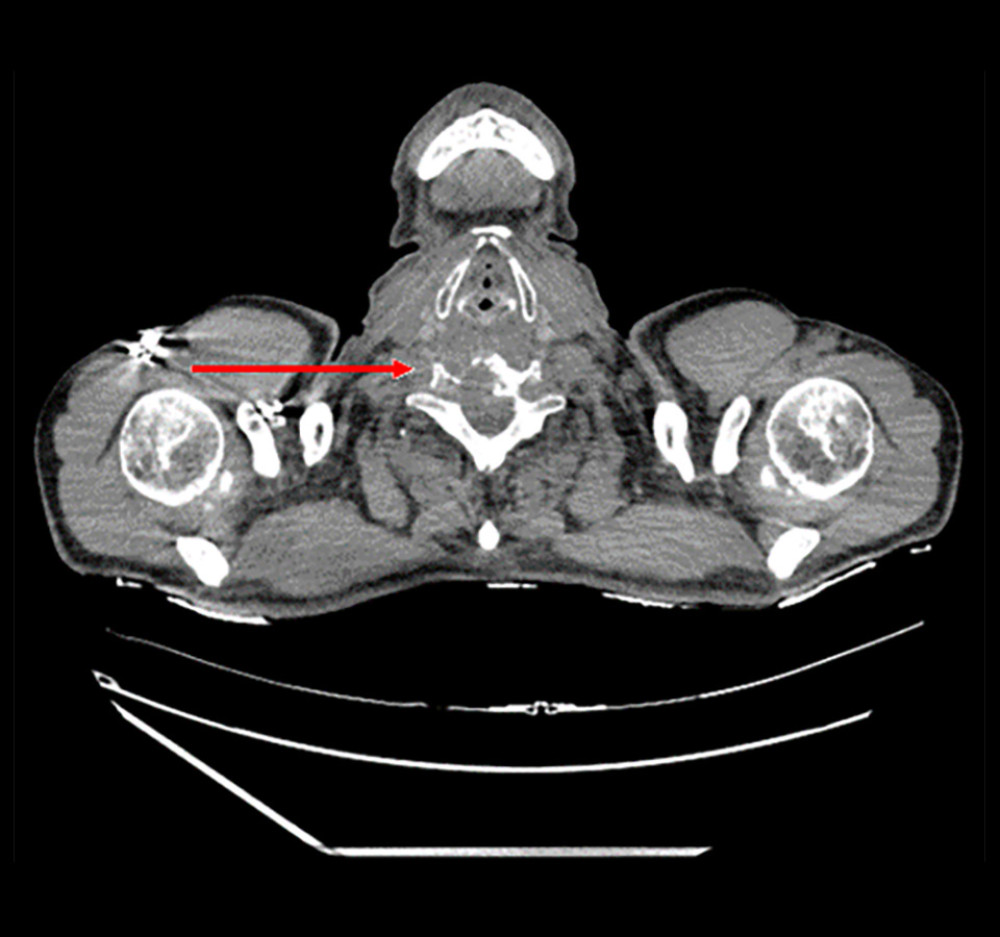 Chest computed tomography scan from March 1, 2023 (contrast-enhanced). The arrow shows destroyed anterior-right parts of the vertebral bodies.