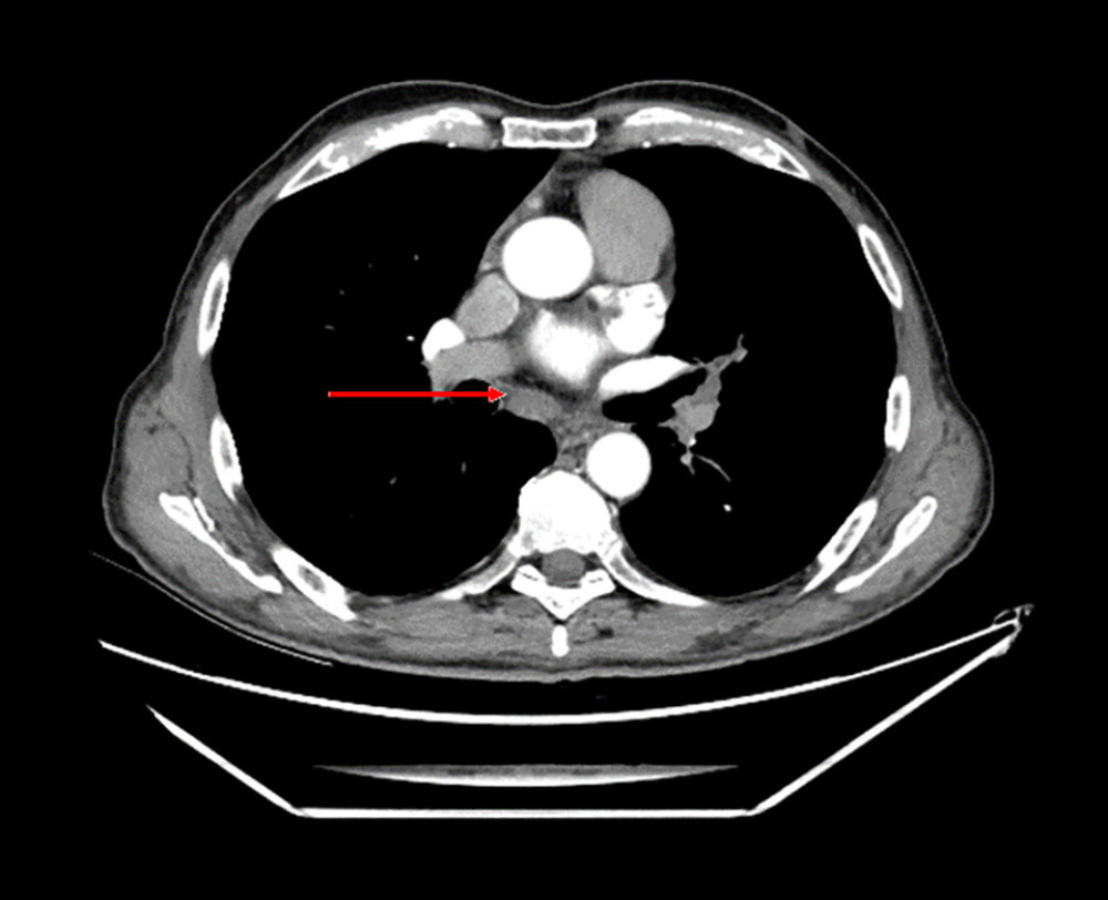 Follow-up computed tomography scan from March 29, 2023 (contrast-enhanced). The arrow indicates a reduced subcarinal lymph node, showing a decrease in size, compared with the previous scan.