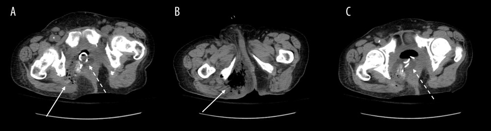 Computed tomography of the abdomen and pelvis at presentation. Images are at the level of the acetabulum of the femur (A, C), and the ischial tuberosities (B). Soft-tissue emphysema can be seen in the right ischiorectal space tracking from a large pelvic cavity (solid arrow). Hyper-reflective ureteral stents are seen within the pelvic cavity (dashed arrow). Image quality is limited by motion artifact.