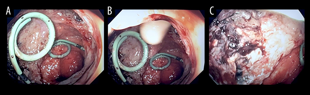 Intraoperative photos from the initial surgery. (A) shows the view from the anus with the ureteral stents within the pelvic cloaca. (B) demonstrates the rectovaginal fistula with the finger in the defect. (C) shows the necrotic right pelvic sidewall tissue prior to initial debridement.