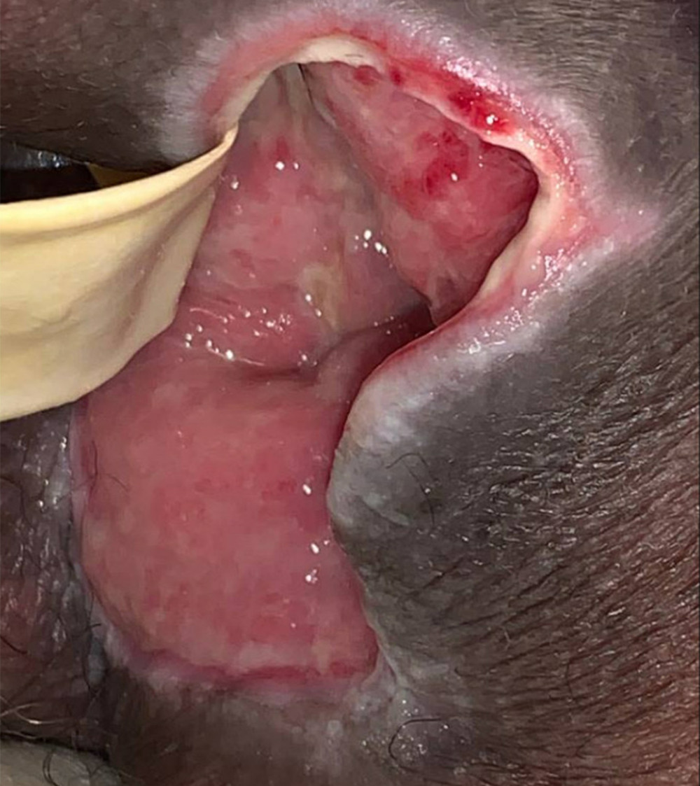 Wound appearance at 2-month follow-up. The wound has significantly decreased in size and healthy granulation tissue is present.
