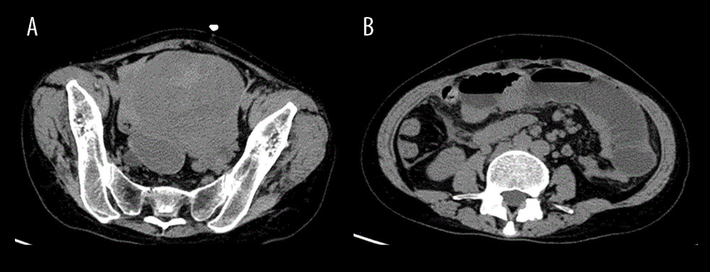 Computed tomography findings. (A) Abdominal computed tomography shows a 10×9×12-mm mixed-density tumor in the pelvic cavity. (B) The tumor caused upstream obstruction of the small intestine.