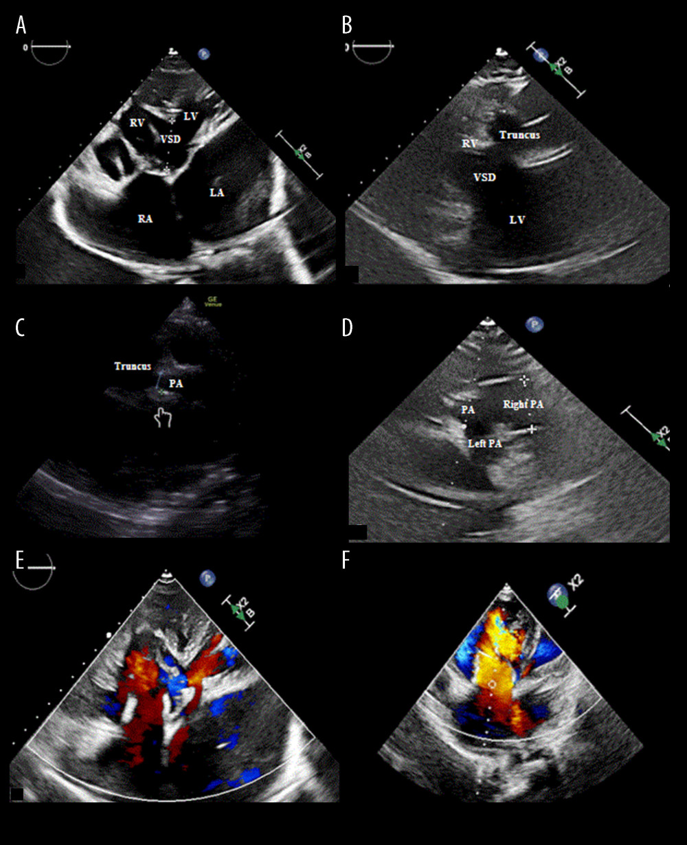 Transthoracic echocardiography. (A) Apical 4-chamber view showing a ventricular septal defect. (B) Parasternal long axis showing a truncus arteriosus arising mainly from the right ventricle. (C) Aortic short axis showing a main pulmonary artery segment originating from the lateral wall of the truncus. (D) Left ventricular long axis showing branch pulmonary arteries are arising from the main pulmonary artery segment. (E) Apical 4-chamber view showing a severe regurgitation of the tricuspid valve. (F) Apical 4-chamber view showing a severe tricuspid regurgitation. LA – left atrium; RA – right atrium; LV – left ventricle; RV – right ventricle; PA – pulmonary artery; VSD – ventricular septal defect.