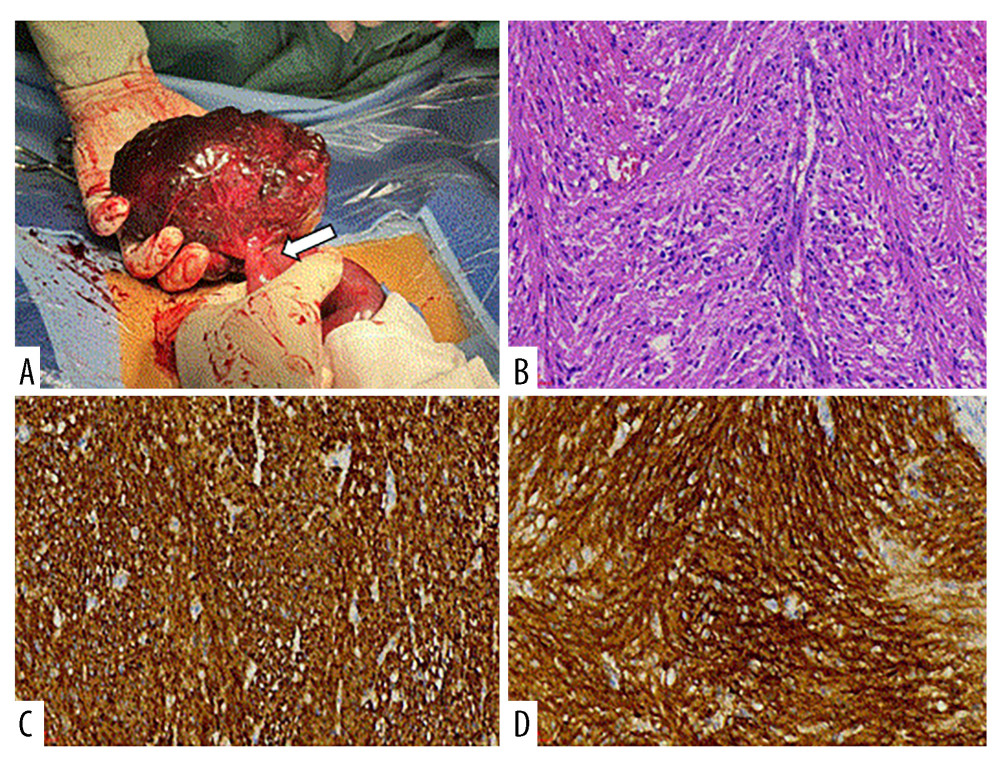 Gross and microscopic features of the tumor. (A) The small bowel gastrointestinal stromal tumor was twisted at the pedicle (arrow), with hemorrhagic necrosis. (B) Hematoxylin and eosin staining showed tightly arranged spindle-shaped cells (×200). Immunohistochemical staining showed CD117 positive cells (C) and DOG1 positive cells (D) (×200).