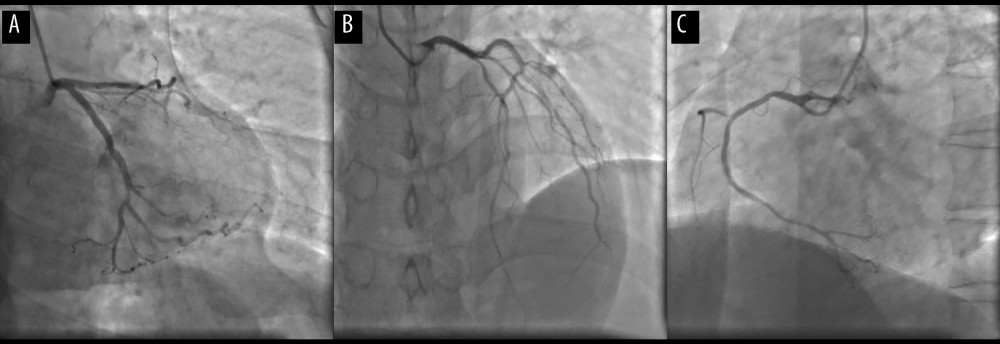 Images of coronary angiography. Left coronary artery (A, B) and right coronary artery (C).