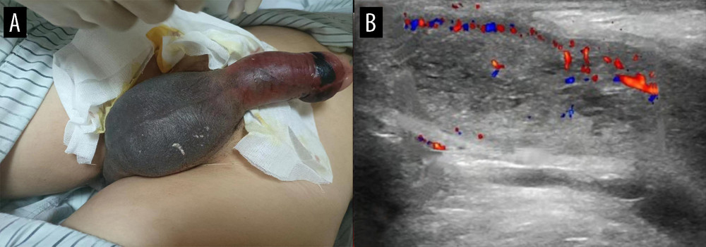 Image of penile erection (A) and venous ultrasound of penis (B) on the first day that priapism is occurred.