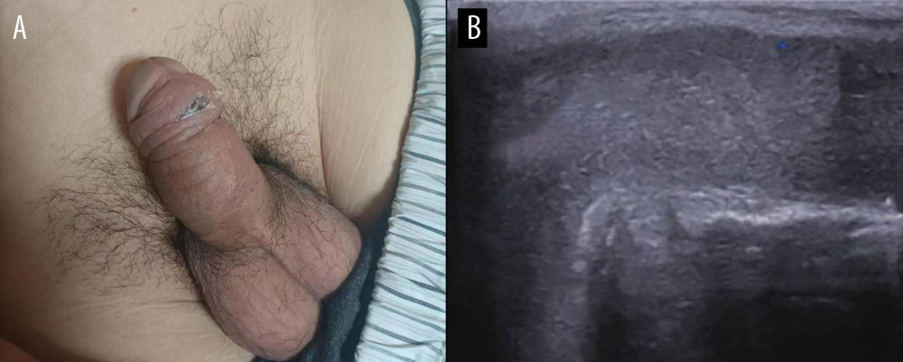 Image of the penis (A) and venous ultrasound of penis (B) after 40 days of treatment.